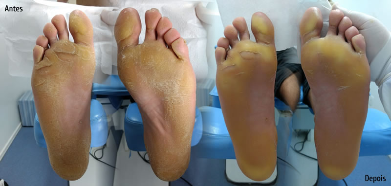 Patologia De Hiperqueratose Epidermolitica